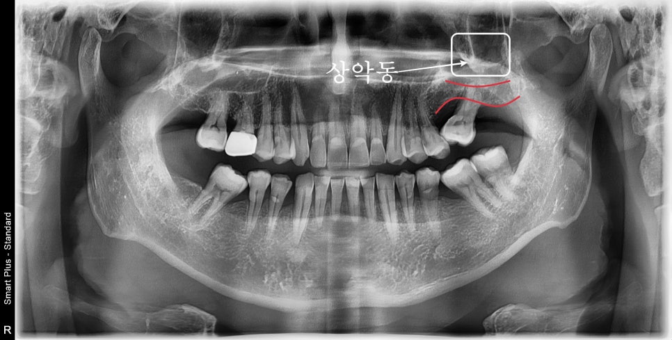 신당동 치과 오래전 빠진 치아 상태에서 임플란트 수술(상악동 거상술) 관련 이미지 1