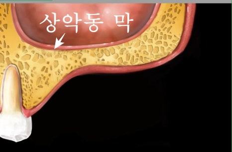 신당동 치과 오래전 빠진 치아 상태에서 임플란트 수술(상악동 거상술) 관련 이미지 2