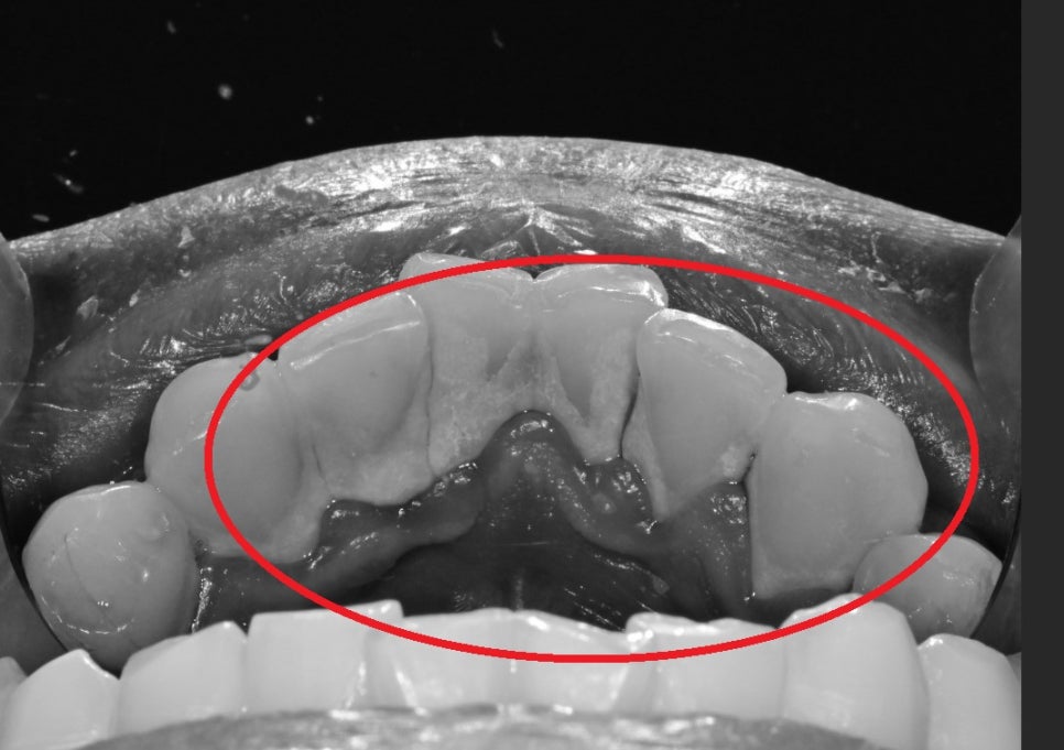 금남시장 치과, 잇몸염증이 생긴다면 원인과 치료 방법은?? ( 양치할 때 피나요, 치아색이 이상해요) 관련 이미지 4