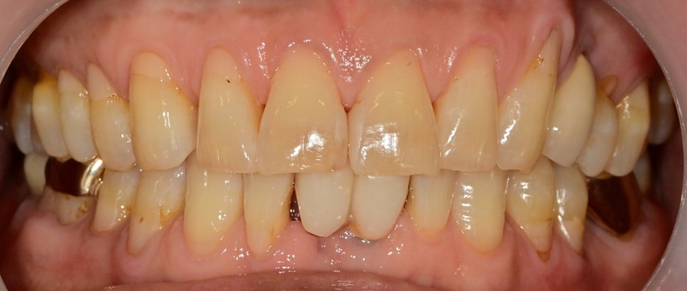 성동구 옥수동 치과 앞니 임플란트수술 즉시 임시치아 제작(구강스캐너를 이용한 수술절차) 관련 이미지 6