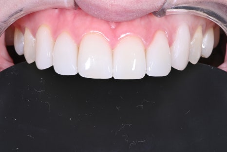 약수역 치과 라미네이트의 완성은 관리에서 시작합니다 관련 이미지 6