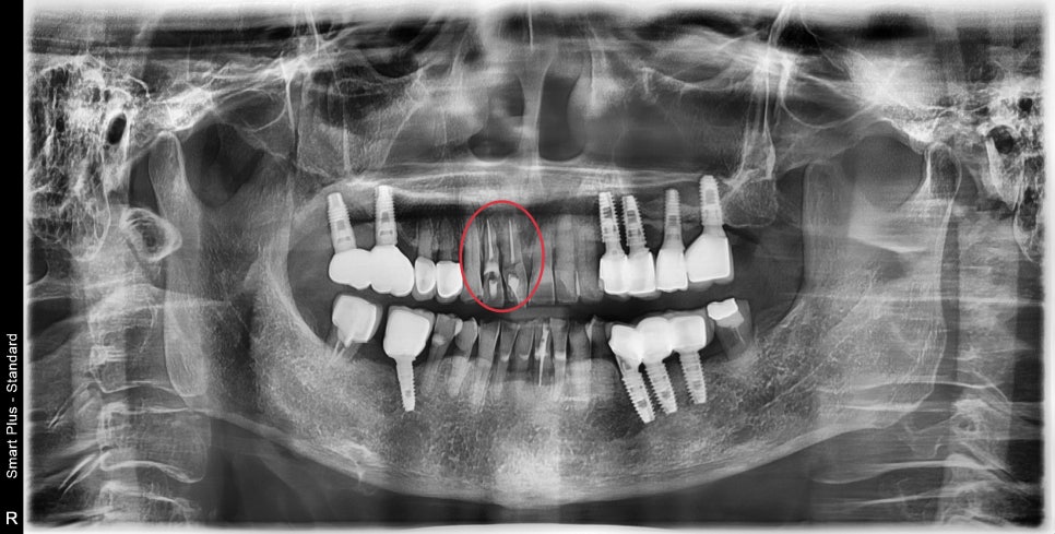 약수동 치과 내려앉은 잇몸 공간 치아삭제 없이 치료하기 관련 이미지 3