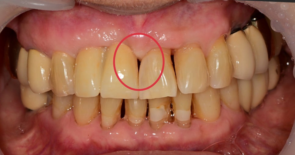 약수동 치과 내려앉은 잇몸 공간 치아삭제 없이 치료하기 관련 이미지 8