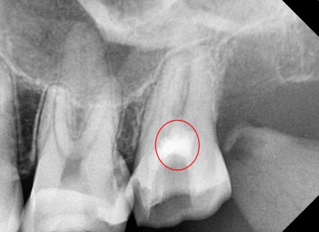 장충동 치과, MTA를 이용한 신경치료 시 주의할 점( 크랙치아, 깊은 충치) 관련 이미지 2