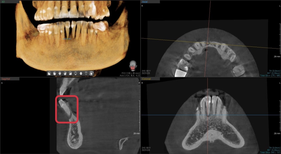 성동구 옥수동 치과 앞니 임플란트수술 즉시 임시치아 제작(구강스캐너를 이용한 수술절차) 관련 이미지 4