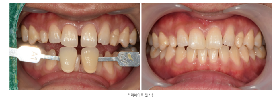 약수역 치과 , 전치부 심미보철 재제작할때 주의할 점 ( 항상 무삭제 라미네이트가 가능한 것인가??) 관련 이미지 5