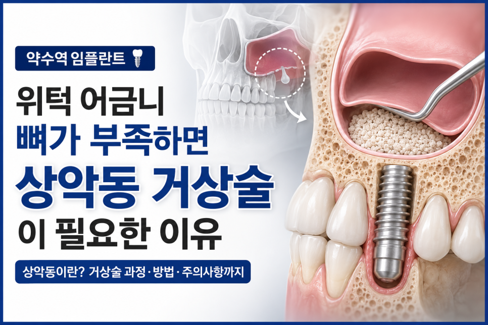 Yak-su Station Dental Clinic: When Is a Sinus Lift Necessary for Implants? image 10