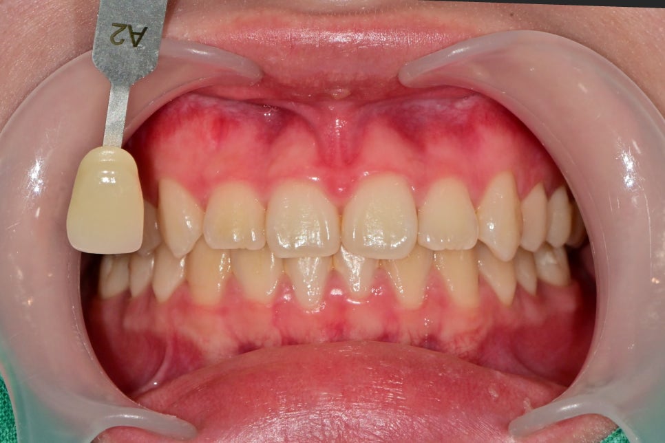 약수역 치과, 치아 미백 1회 방문으로 효과가 있을까?(feat. 원데이 미백) 관련 이미지 7