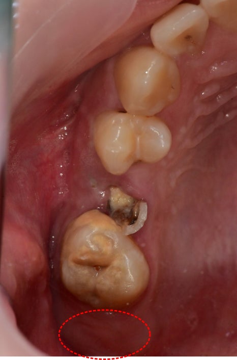 금호동 논골사거리 근처 치과에서 영구치 치료를 위한 잇몸성형술 관련 이미지 3