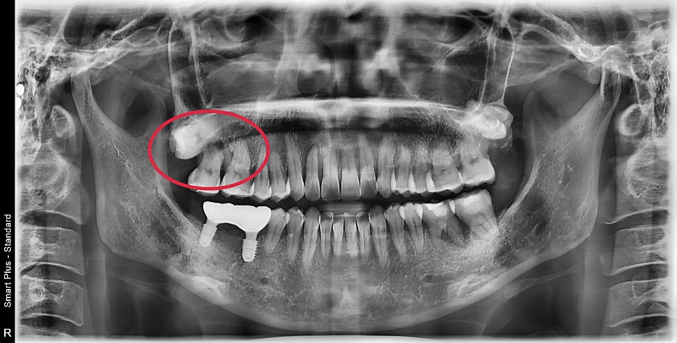 약수동 임플란트 염증으로 인한 발치 후 임플란트 식립( 상악동 거상술) 관련 이미지 2