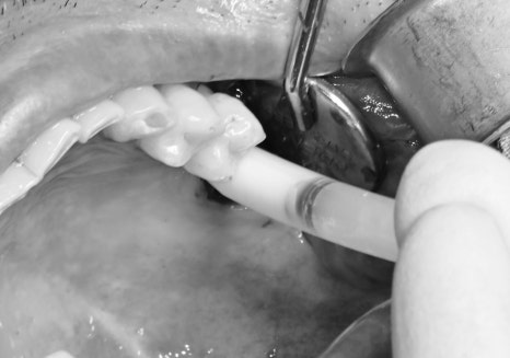 신당동 치과 오래전 빠진 치아 상태에서 임플란트 수술(상악동 거상술) 관련 이미지 6