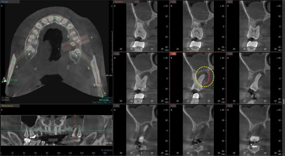 약수역 임플란트, 발치 후 임플란트 수술 언제 가능한가? 관련 이미지 5