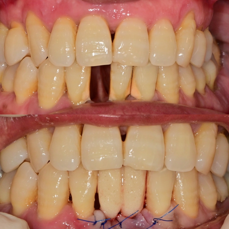 금호동 치과 앞니 임플란트 수술 후 빈 공간 임시로 회복하는 방법 관련 이미지 2