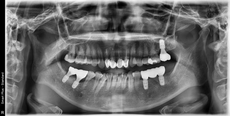 신금호역 주변 치과 치아가 빠진 후 시간이 오래 지나면 생기는 문제점 관련 이미지 7
