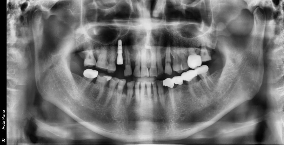 신당동 치과 씹을 때마다 아플 때 임플란트 치아의 문제 관련 이미지 6