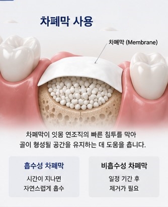 약수역 임플란트, 뼈이식 없이 가능한 경우도 있을까요? 관련 이미지 2