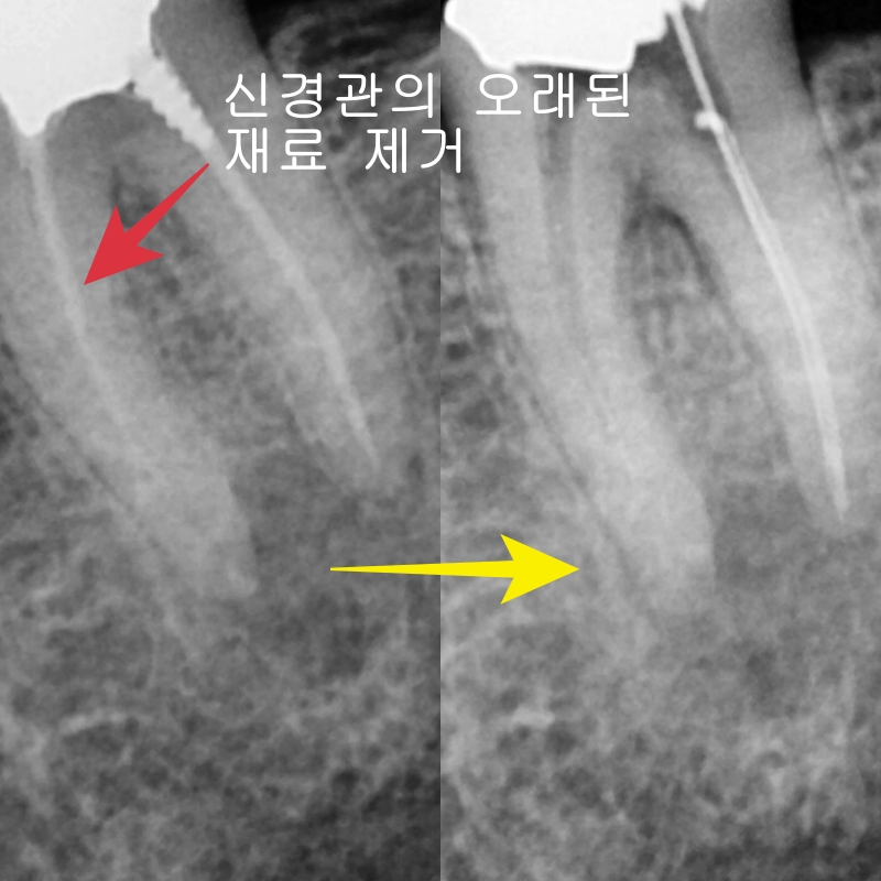 옥수동 크라운치료된 통증 있는 치아의 (재)신경치료 과정 관련 이미지 10