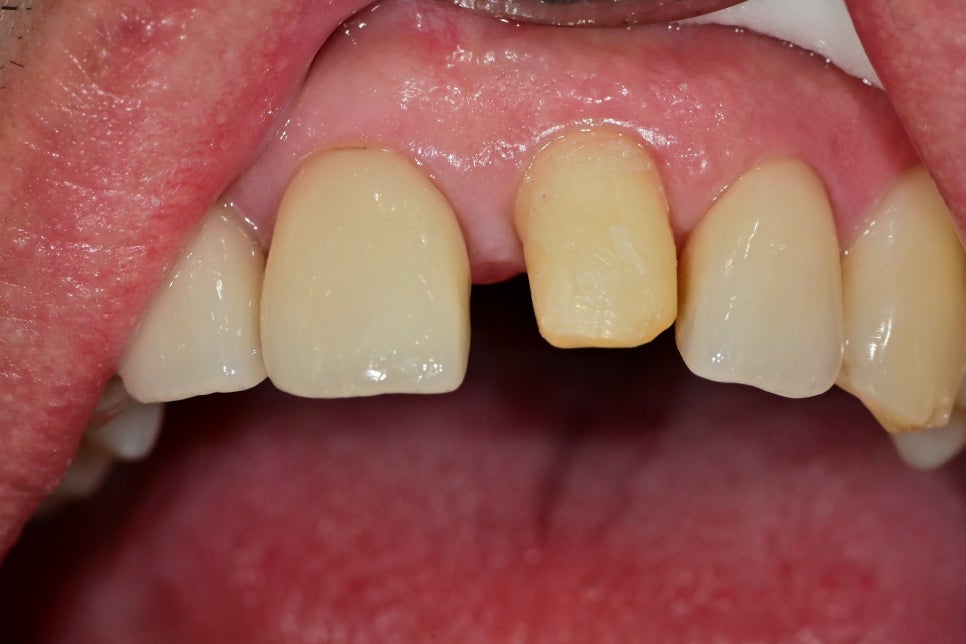 약수역 치과, 전치부 심미 보철 재치료(보철물 파절의 원인) 관련 이미지 4