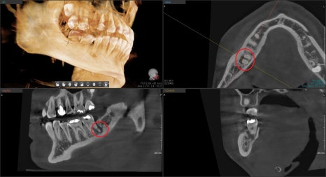 약수역 치과, 금 간 치아( 크랙 치아)로 인한 뿌리 주변 염증이 생겼을 때 치료방법( 임플란트, 치조골 이식술) 관련 이미지 2
