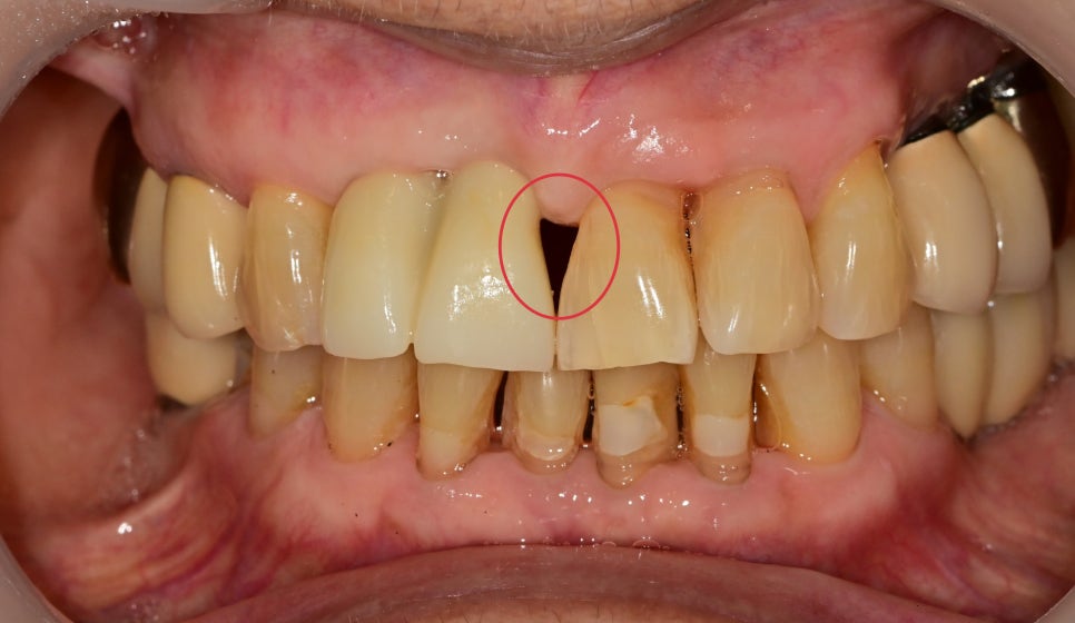 약수동 치과 내려앉은 잇몸 공간 치아삭제 없이 치료하기 관련 이미지 6