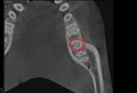 약수역 치과, 어려운 신경형태의 치아 신경치료 할때 주의할점 ( C형 근관, 신경관 찾기, 치아보존치료) 관련 이미지 5