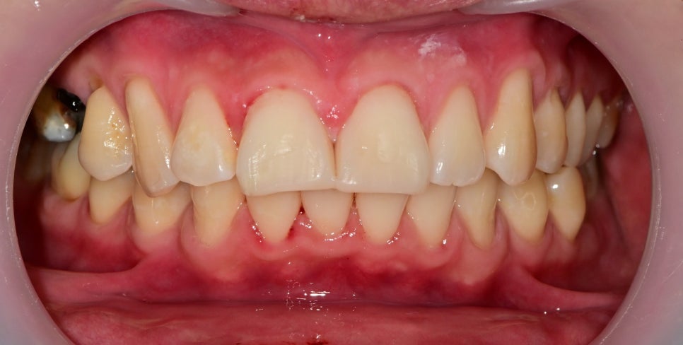 버티고개역 치과 앞니 외상에 따른 치료방법( 넘어져서 치아가 부러졌어요) 관련 이미지 5