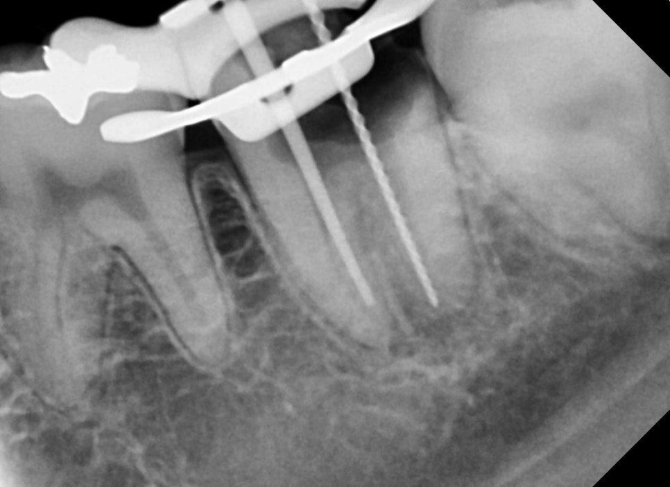 청구역 치과, 충치가 생긴 치아를 초기에 치료를 미루면 안되는 이유!! ( 신경염증, 뿌리주변 염증, 보철치료를 위한 사랑니 발치) 관련 이미지 3
