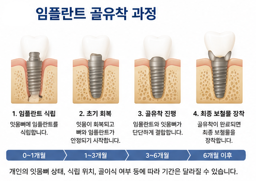 약수역 전체임플란트, 수술 후 즉시 임시치아는 어떻게 관리할까요? 관련 이미지 2
