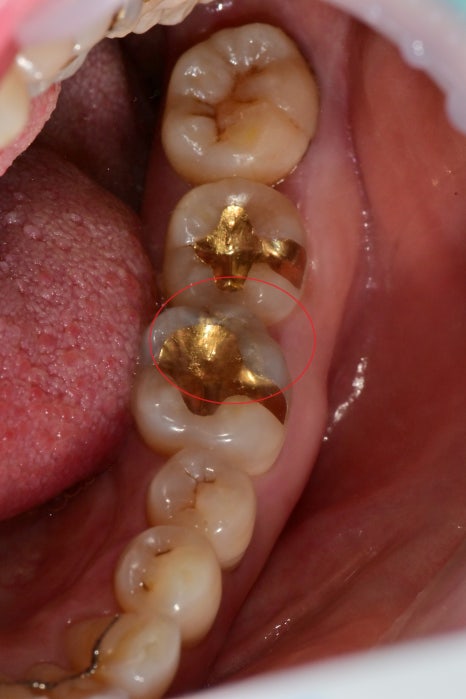 약수동 치과, crack 치아 (금간 치아)의 오래된 수복물 제거 후 치료방법( MTA, 깊은충치) 관련 이미지 1