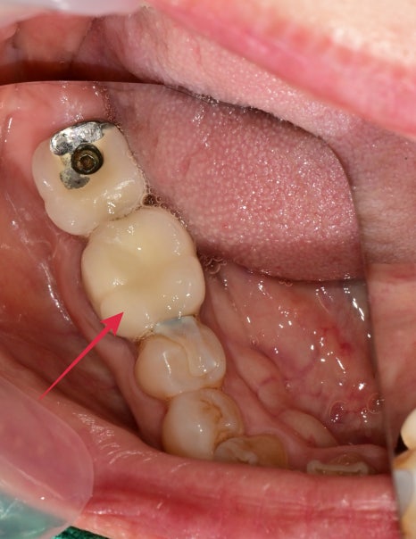 옥수동 크라운치료된 통증 있는 치아의 (재)신경치료 과정 관련 이미지 1