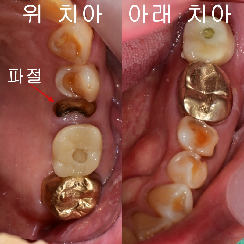 버티고개역 치과 깨지고 닳은 치아 회복하는 방법 관련 이미지 1