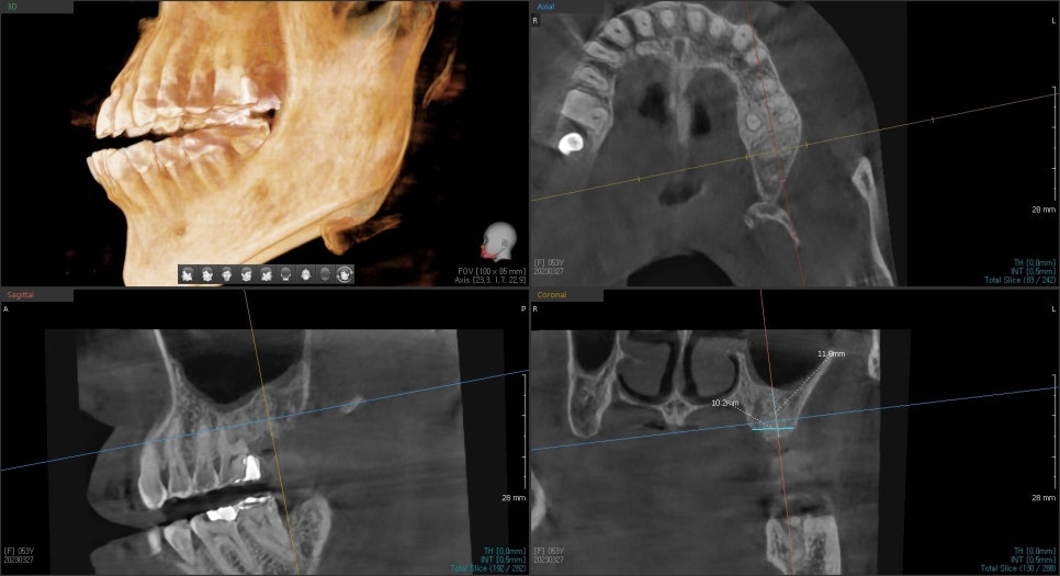 약수역 치과, 신경치료된 치아 뿌리 주변 염증이 생겼을 때 발치 후 발치와 보존술 처치( 임플란트 식립을 위한 치료 ) 관련 이미지 4