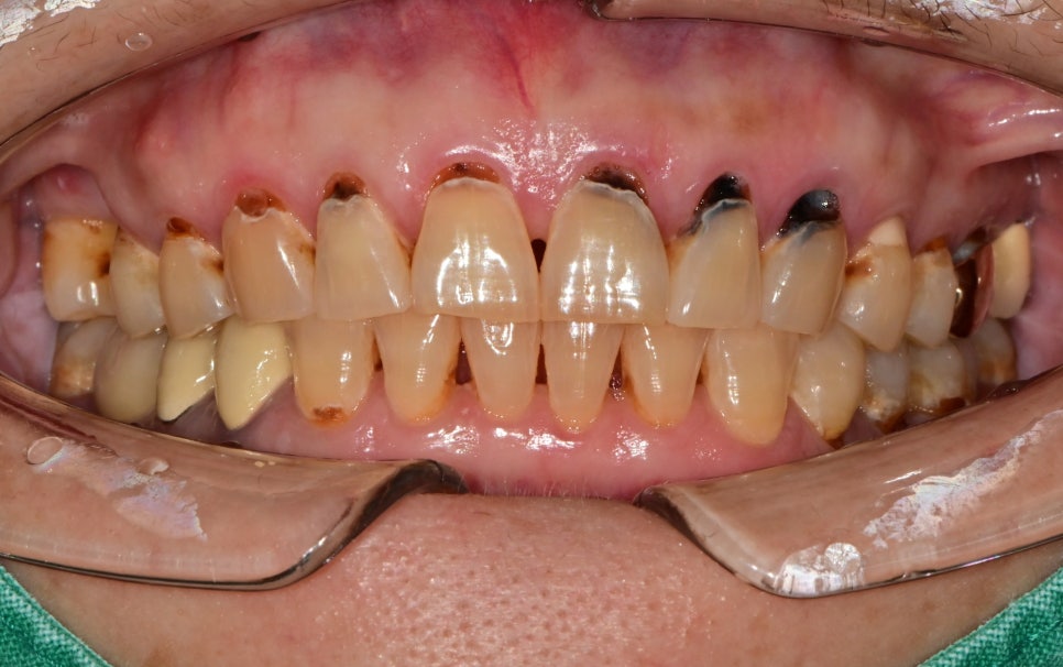 옥수동 치과 앞니 충치가 생기는 원인, 치료방법 (심미치료, 레진) 관련 이미지 1