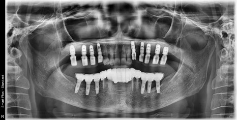 신당 임플란트, 심을까 말까 고민되신다면?? (고난도 골이식 임플란트 기간 및 통증) 관련 이미지 11