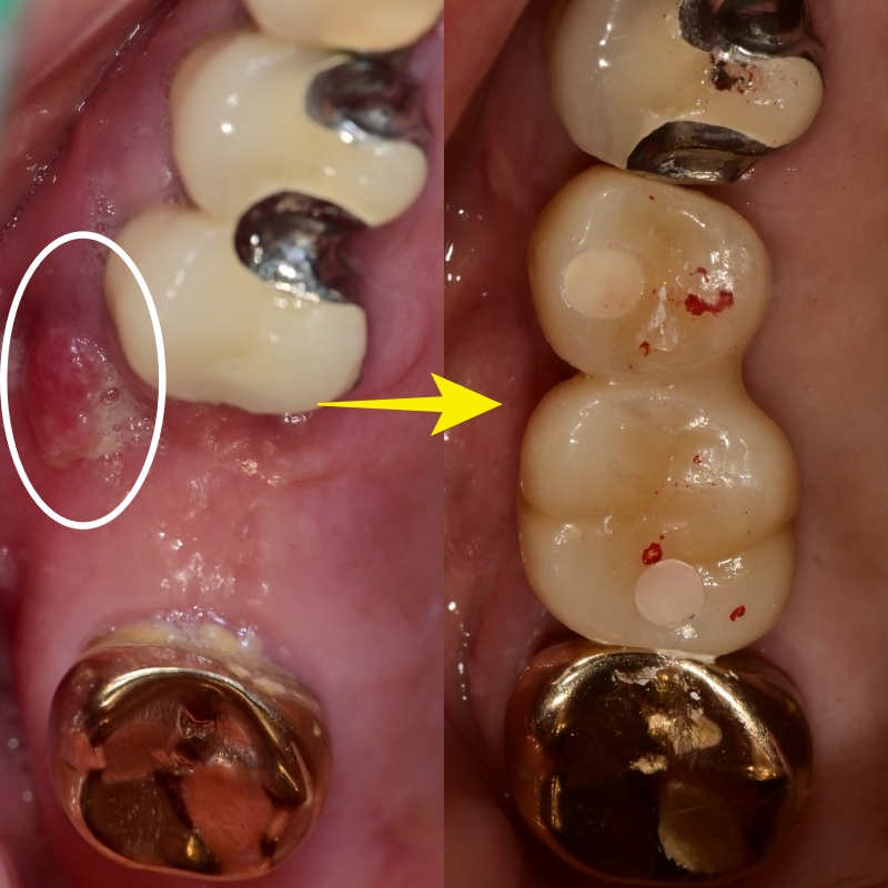 신당 치과 틀니보다 임플란트가 좋은 이유 관련 이미지 5