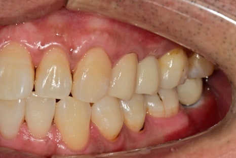 장충동 주변 치과 오래된 충치, 빠진 치아 부위 치료 방법 관련 이미지 8