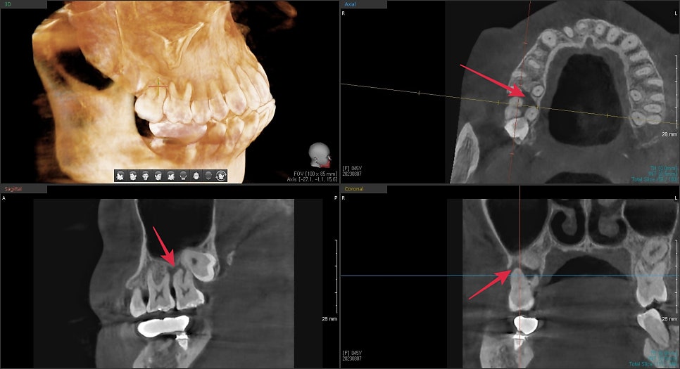 약수동 임플란트 염증으로 인한 발치 후 임플란트 식립( 상악동 거상술) 관련 이미지 3