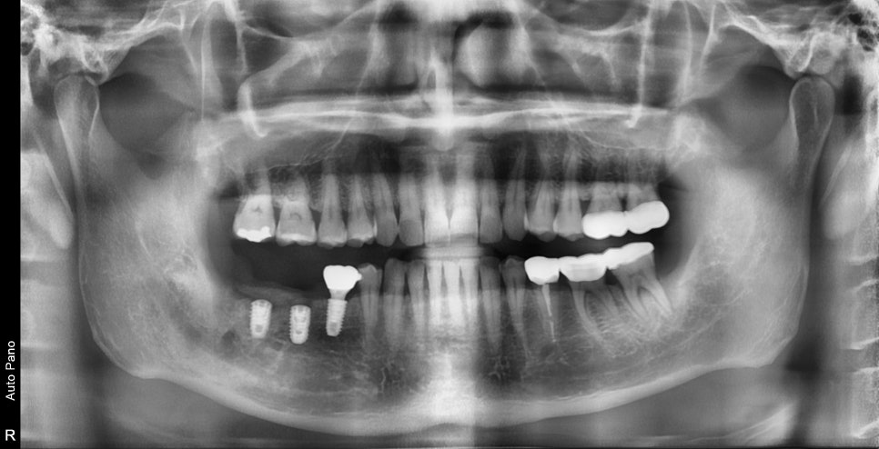 동대문 치아뿌리 염증 방치하면 치과 임플란트 기간에 영향을 줍니다 관련 이미지 7