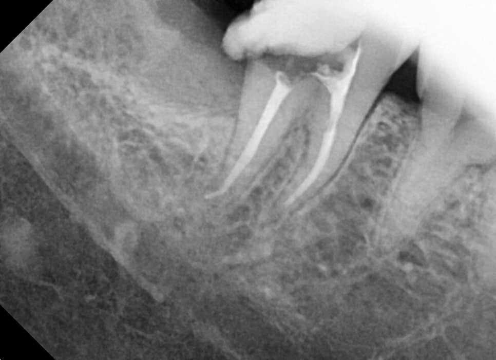 약수역 치과, 매복 사랑니 발치 (신경치료, 크라운치료) 관련 이미지 3