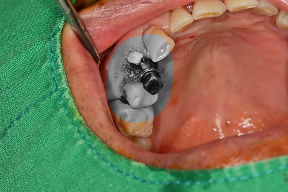 신당동 치과 씹을 때마다 아플 때 임플란트 치아의 문제 관련 이미지 5