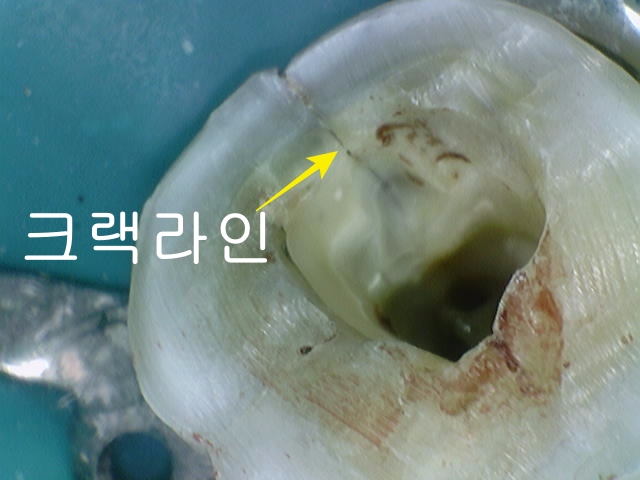 광희동 주변 치과 치아 크랙으로 인한 증상 신경치료 관련 이미지 3