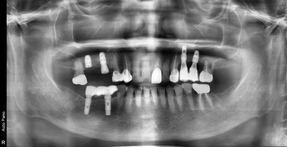 신당 치과 틀니보다 임플란트가 좋은 이유 관련 이미지 3