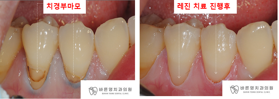 약수역 치과, 치경부마모증 치아에는 어떤 치료를 해야될까요??(시린이 치아의 원인과 해결방법) 관련 이미지 4