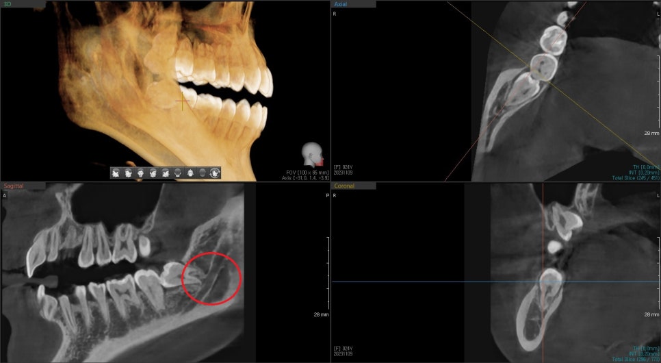 신당동 치과, 사랑니는 꼭 빼야 하나요?? 매복 사랑니 발치 시 유의할 점? (발치 후 통증 및 붓기) 관련 이미지 2