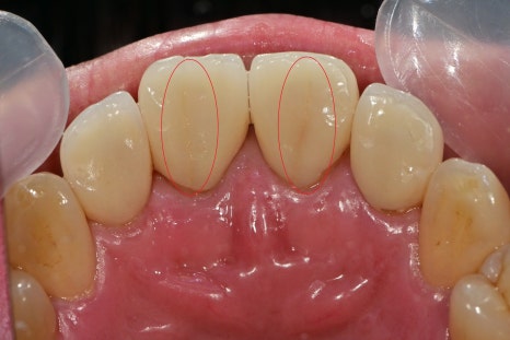 한남동 주변 치과 외상에 의해 앞니가 깨졌을 때 범위에 따른 치료방법 관련 이미지 4