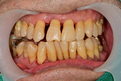 청구역 치과 치주염으로 다수의 치아가 흔들리는 경우(발치, 임플란트) 관련 이미지 4