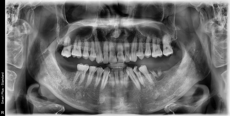 약수역 치과, 미뤄둔 임플란트 치료하기 (치과가 무서워요) 관련 이미지 5