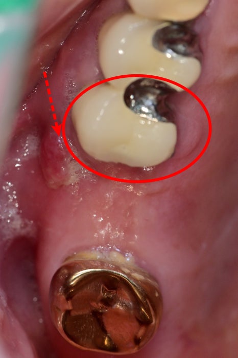 신금호 치과 , 틀니를 오래 쓰면 치아에 생기는 문제점 관련 이미지 3