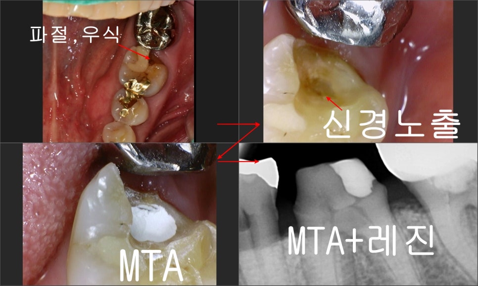 장충동 치과, MTA를 이용한 신경치료 시 주의할 점( 크랙치아, 깊은 충치) 관련 이미지 11