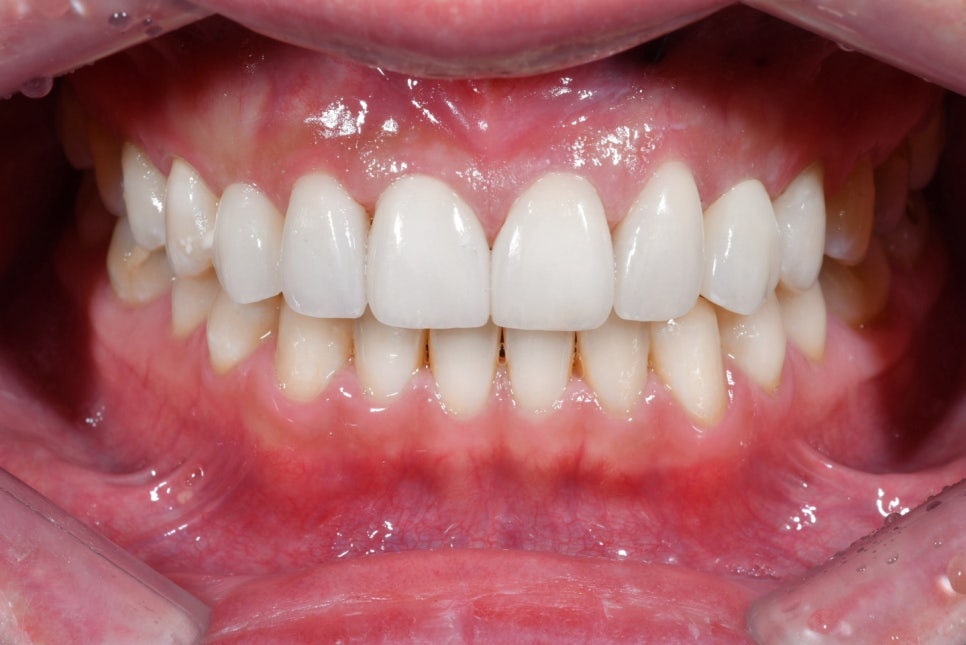 청구동 치과 앞니 라미네이트를 하는 이유 관련 이미지 8